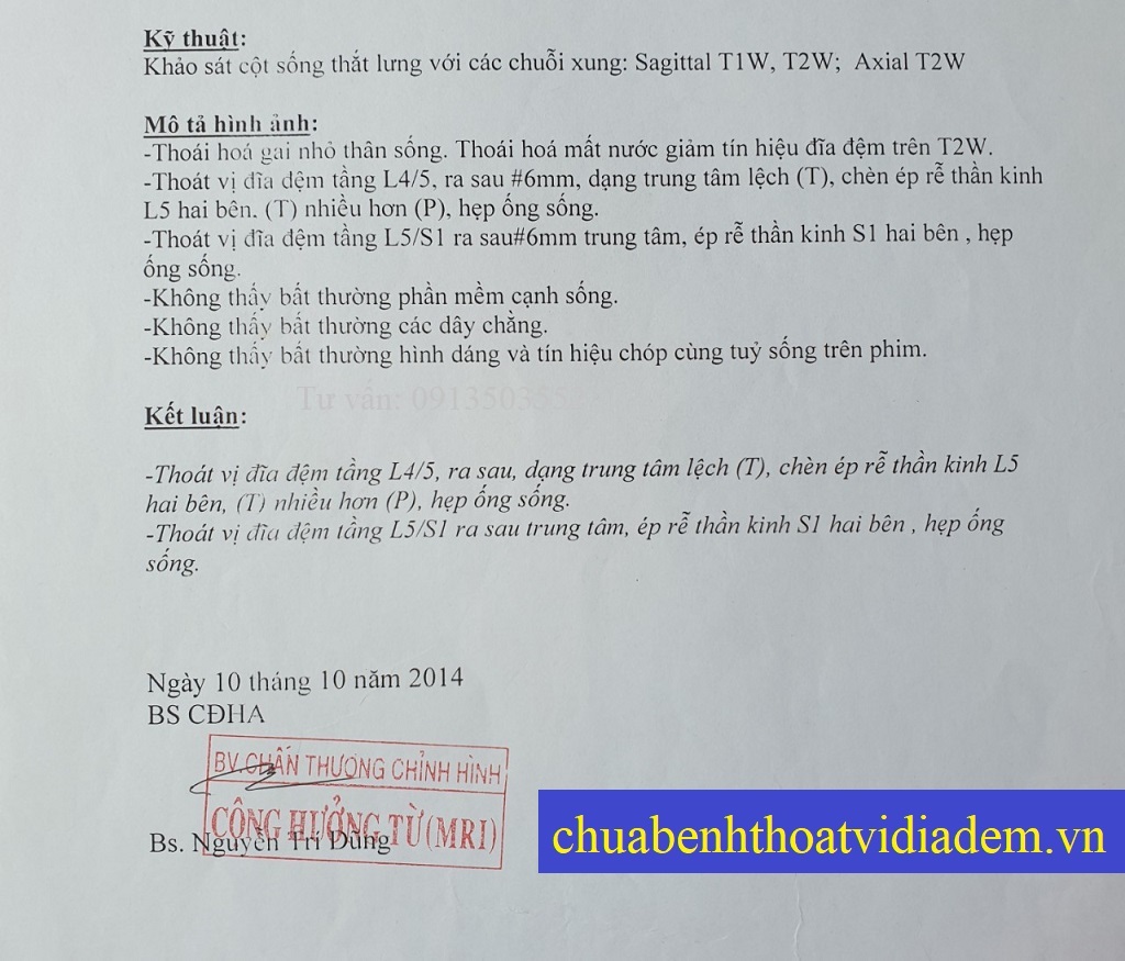 Thoát vị đĩa đệm lưng